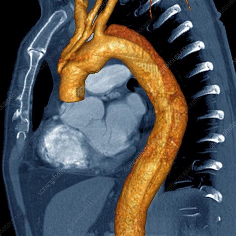 Aortic Aneurysm 3d Angio Ct Scan Stock Image C0096812 Science