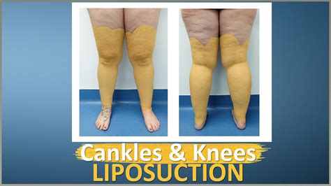 Lipo 360° Legs Liposuction Results Cankles And Knees Lipedema Surgery Expert Dr Thomas Su