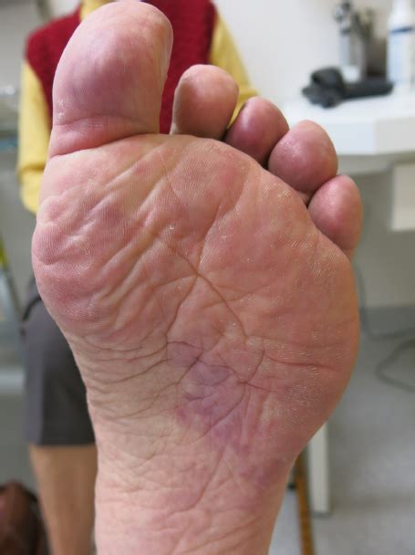 Palmar Erythema With Slight Edema Toes Are Involved As Well