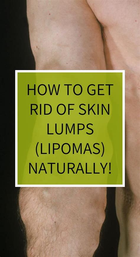 How To Get Rid Of Skin Lumps Lipomas Naturally How To