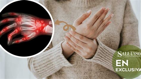 Artritis reumatoide en mujeres jóvenes causas mitos y tratamiento