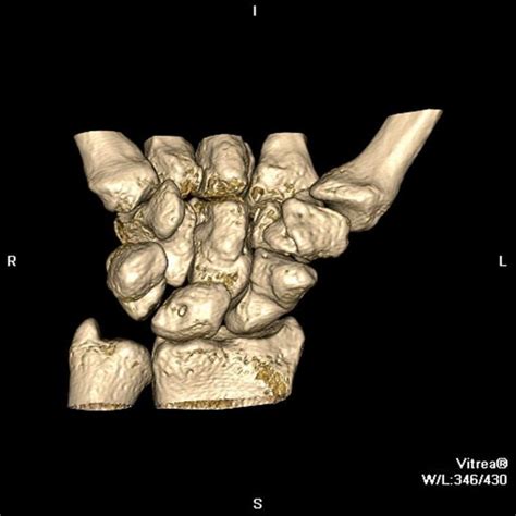 Image Computed Tomography Ct Of The Wrist 3 Dimensional