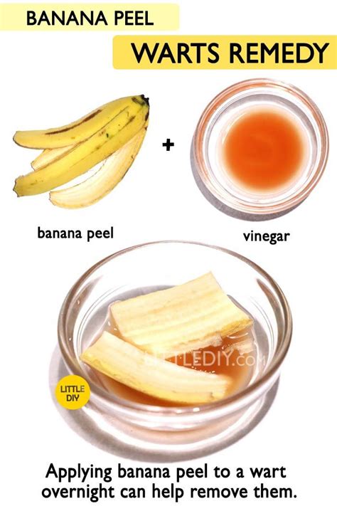 How To Remove Warts With Banana Peel Banana Poster