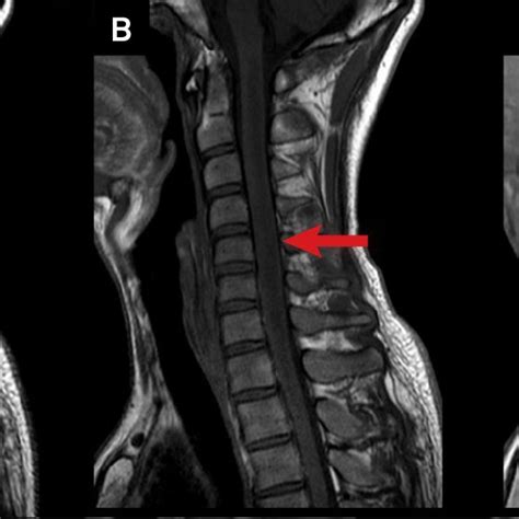 A Sagittal T Weighted Cervical Spine MRI Showing A Heterogeneous Download Scientific Diagram