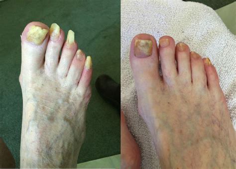 Before And After Gallery Advanced Foot Care