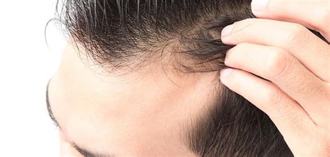 Signs Of A Receding Hairline Vlrengbr