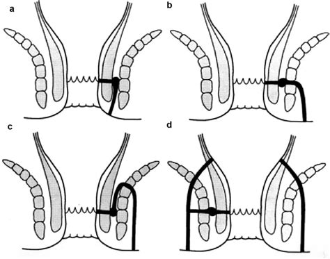 Fistula In Ano Springerlink