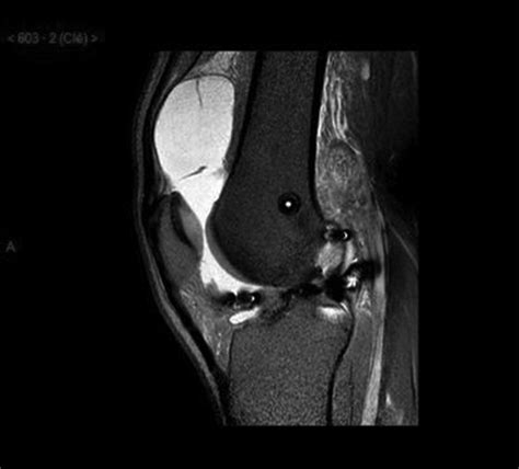 New Aetiology Of Patellofemoral Pain Syndrome Bmj Case Reports