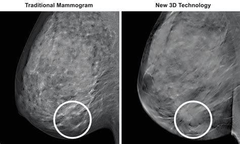 3d Mammography Tm Medical Associates Of Northwest Arkansas
