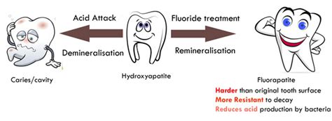 Preventive Dentistry Fluoride Treatment In Children To Prevent Tooth