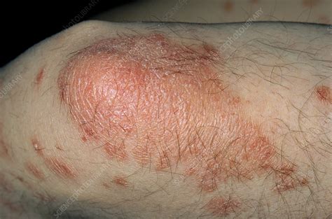 Psoriasis Stock Image M2400403 Science Photo Library