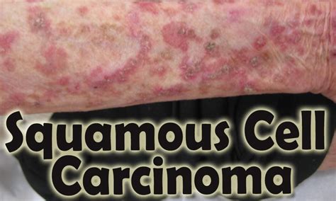 Squamous Cell Carcinoma Skin Cancer Early Stages