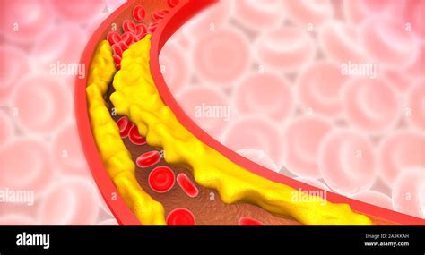 Blocked Artery Cholesterol Hi Res Stock Photography And Images Alamy