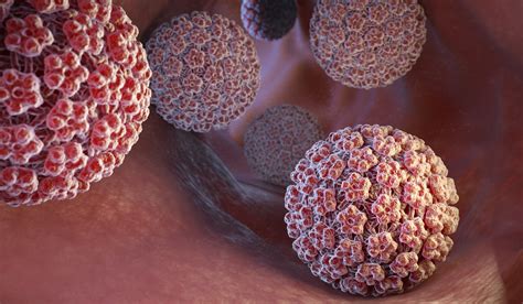 La determinación de dos biomarcadores confirma que el VPH es la causa del carcinoma escamoso