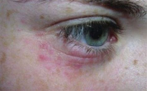 Minor Rashes Around The Eyes As Manifested By Redness And Swelling