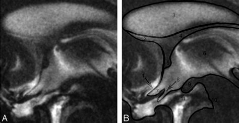 mr imaging and quantification of the movement of the lamina terminalis depending on the csf