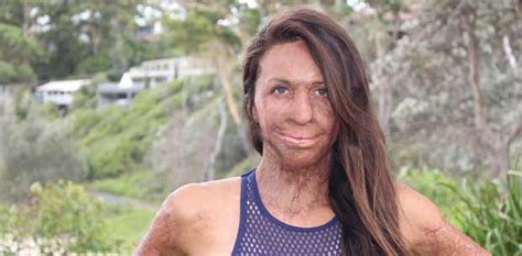 Im Going To Be In A Bit Of Pain Turia Pitt Reveals Shes Undergone Another Surgery Oversixty