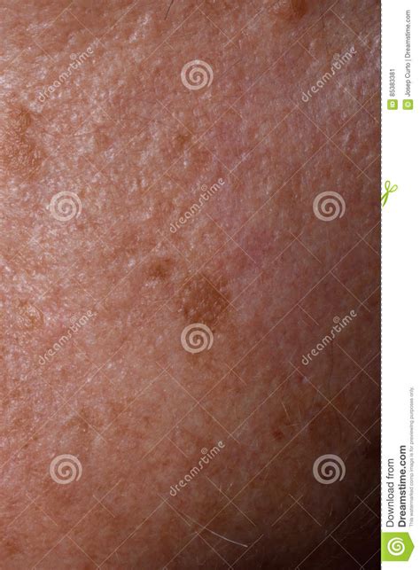 Spots Stock Image Image Of White Person Liver Dark 85383381