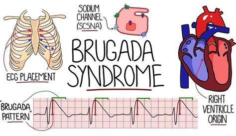 Brugada Syndrome Causes Symptoms Risks Treatment Anxiety Fighters