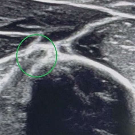 Ultrasound Scan Showing Correct Transverse Section Of Radial Nerve The