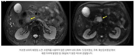 췌장의 종괴 및 전이 여부 등 많은 정보들을 ct로 확인할 수 있다. 췌장암 조기진단, 어떤 검사가 좋을까요? - 전문의칼럼