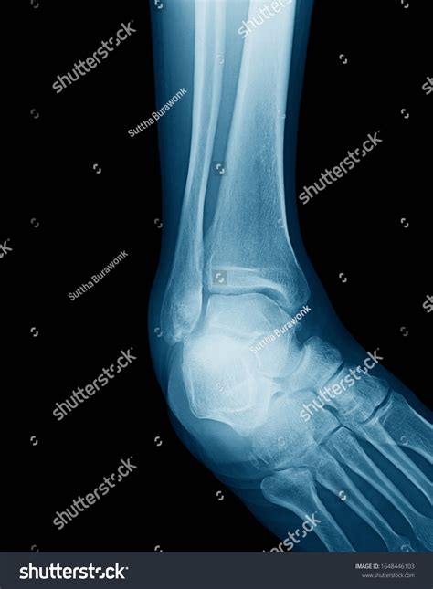 X Ray Image Right Ankle Joint Mortise Stock Photo 1648446103 Shutterstock