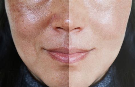 Ipl Photofacial Age Spots And Sun Damage Skin Rejuvenation