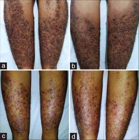 Vesicular Lesions In Lichen Amyloidosis Indian Journal Of Dermatology