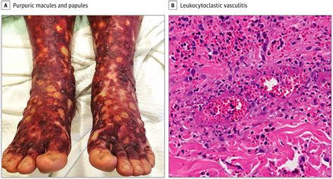 Eosinophilic Granulomatosis With Polyangiitis Allergy And Clinical