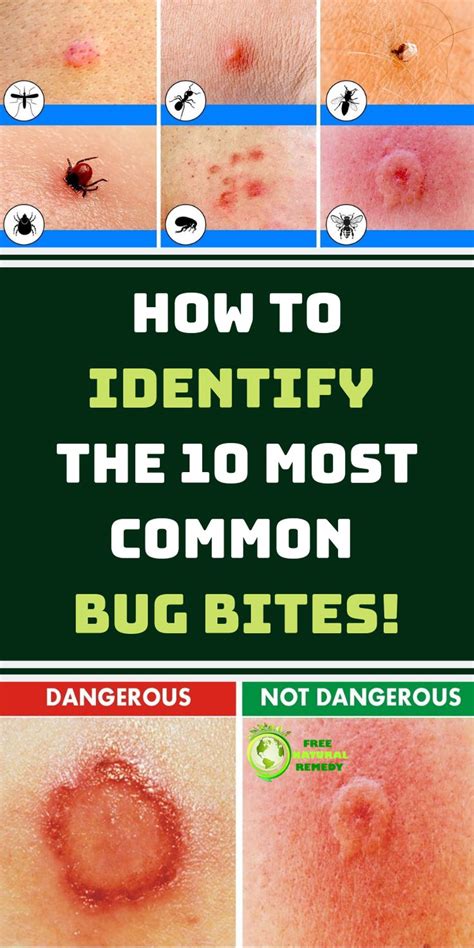 How To Identify The 10 Most Common Bug Bites Bug Bites Natural