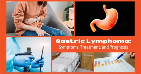 Gastric Lymphoma Symptoms Treatment And Prognosis Mylymphomateam