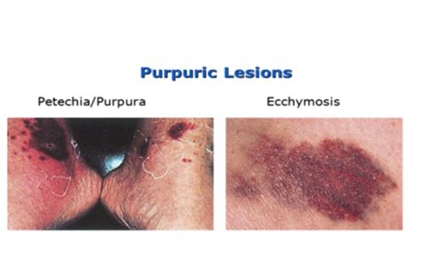 Vascular And Purpuric Lesions Of The Skin Pictures Flashcards Quizlet