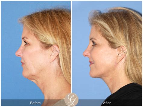 Facelift Fifties Before And After Photos Patient 49 Dr Kevin Sadati