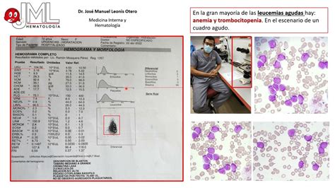 Hemograma Y Frotis De Sangre Perif Rica En Leucemia Aguda Youtube