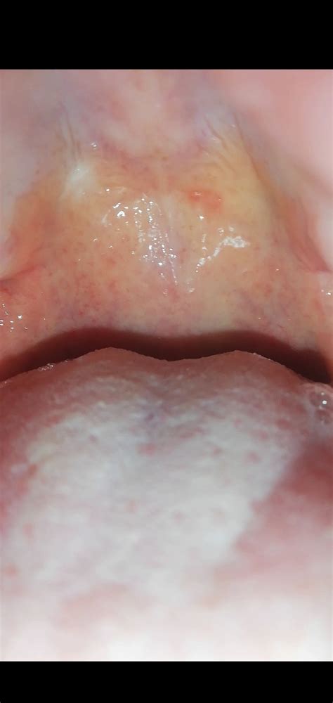 Large Bump On Roof Of Mouth