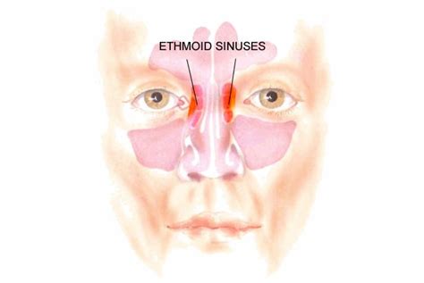Sinus Infection Sinusitis Rhinosinusitis Harley Street Ent Clinic