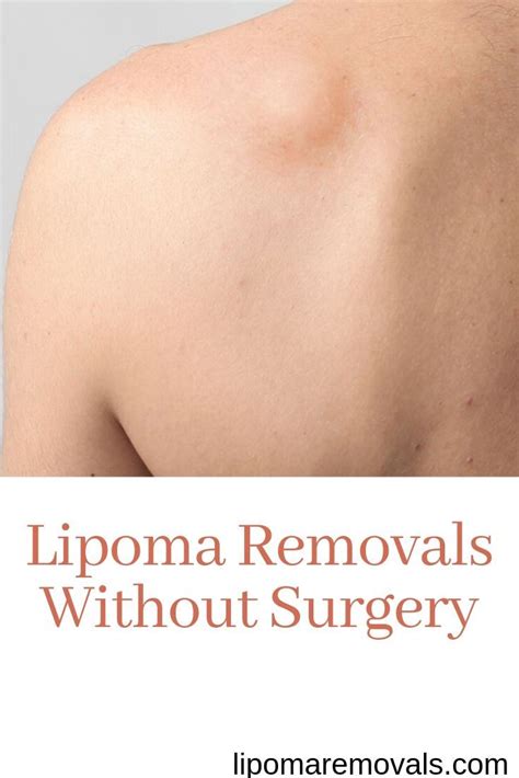 How To Remove A Lipoma Yourself Naturally