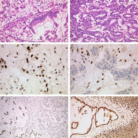 Histomorphology In Msi Gastric Cancers Diffuse And Solid Sheets Of