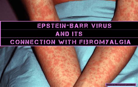 Ebv Is The Possible Cause Of Fibromyalgia Research