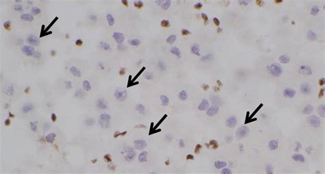 Maybe you would like to learn more about one of these? Earlier diagnosis for people with mesothelioma ...