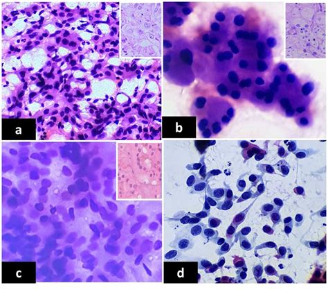 Cytology And Corresponding Histopathology If Available From Kidney
