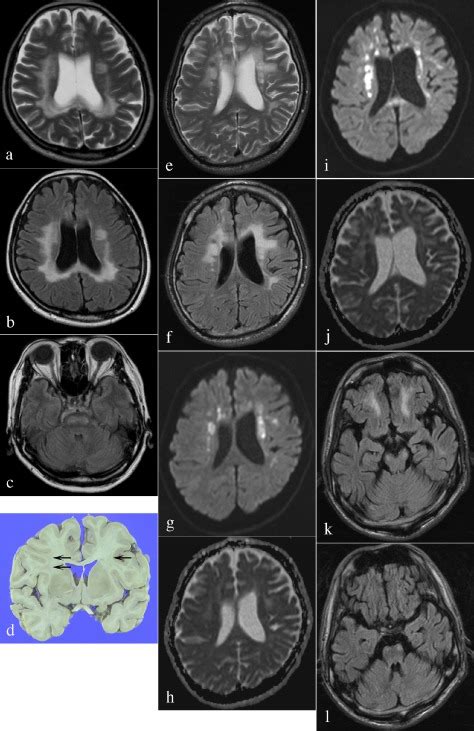 The Mri Of Case 1 Ac Shows A High Intensity Signal In The Cerebral