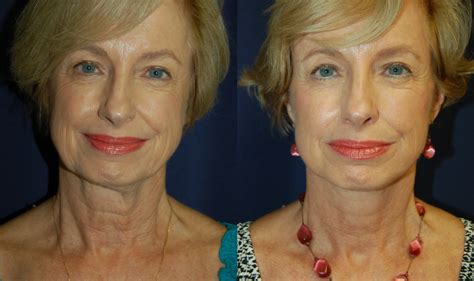 Facelift Procedure Before After Photos Of Complete Facial Rejuvenation