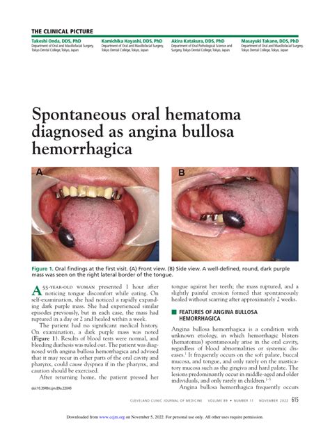 Pdf Spontaneous Oral Hematoma Diagnosed As Angina Bullosa Hemorrhagica