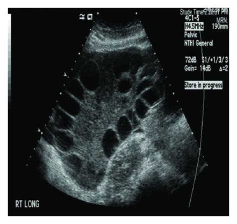 Ovarian Follicle Ultrasound