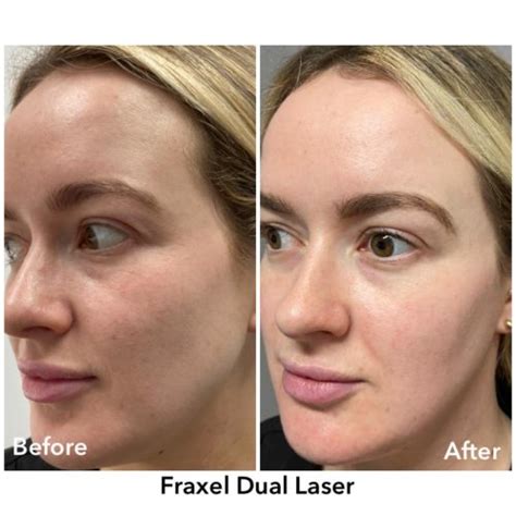 Fraxel® Laser Treatment Ultimate Aesthetics