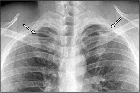 Chest Radiograph Showing Acute Linear Fracture Of Right First Rib And