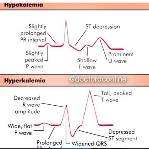 Doctor Doctordconline Hypokalemia Vs H Instagram Hyperkalemia