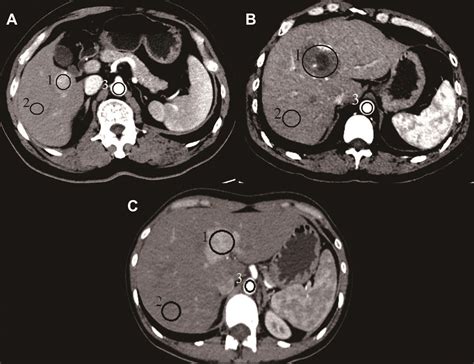 Differentiation Of Hepatocellular Carcinoma From Hepatic Hemangioma And