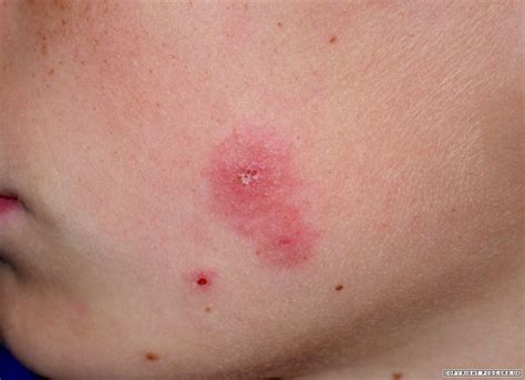 Ringworm On Cheek Pictures Photos